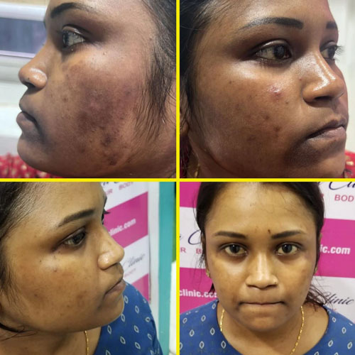 Before and after pigmentation treatment results at Vishaka Clinic